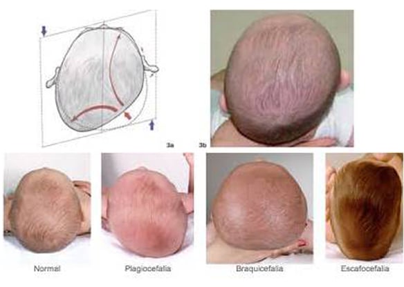 plagiocefalia-cabeza