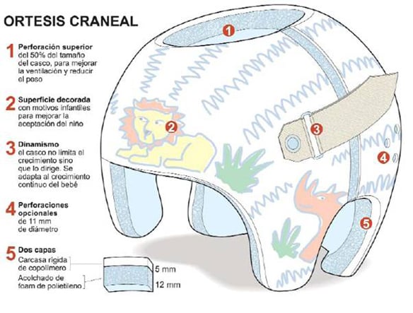 plagiocefalia-casco.partes